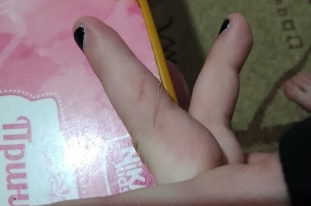    На пальцах девочки - глубокие порезы от ногтей. Фото: Из личного архивa/ Татьяна Черных