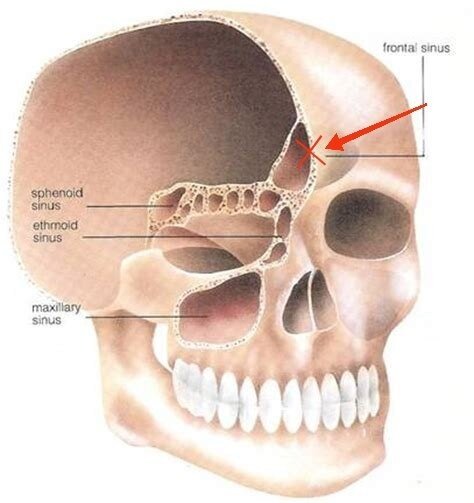 Sinus maxillaris стенки