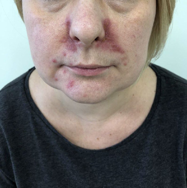 Стероидный дерматит. Несколько лет примениния гормональных мазей. Фото с приёма.