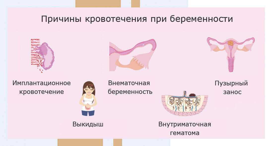 Кровотечения после задержки месячных. Shape of normal pregnancy.