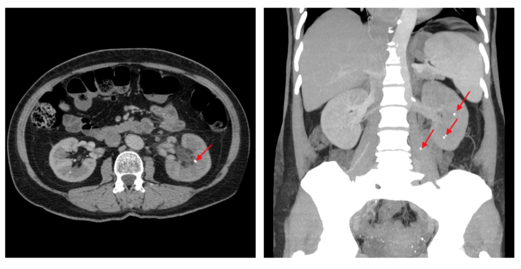 Ркт почек с контрастированием. Компьютерная томография мочекаменной болезни. Коралловидный камень кт. Коралловидный камень в почке кт. Мочекаменная болезнь кт.