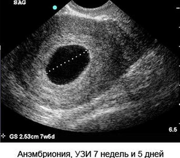 Анэмбриония после ЭКО - признаки и причины