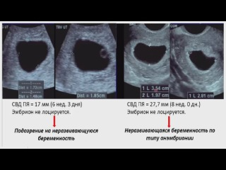 Анэмбриония: причины, симптомы, последствия