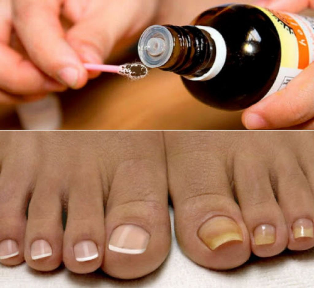 Как применять йод при грибке? 