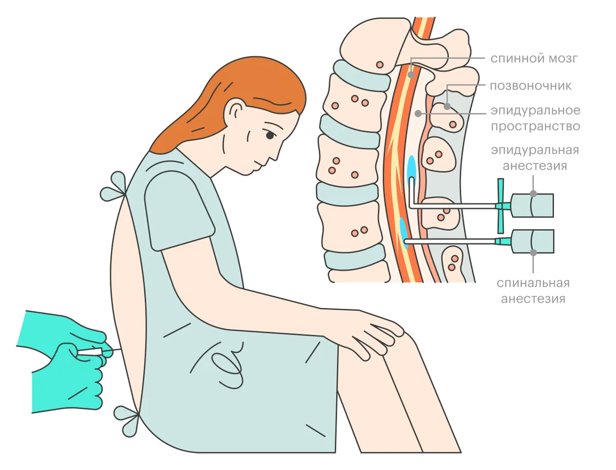Люмбальная эпидуральная анестезия. Эпидуральная анестезия хирургия. Спинальная и эпидуральная анестезия. Эпидуральная анестезия анестетик.