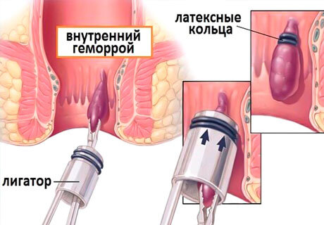 Как выглядит слизистая после лигирования геморроя фото