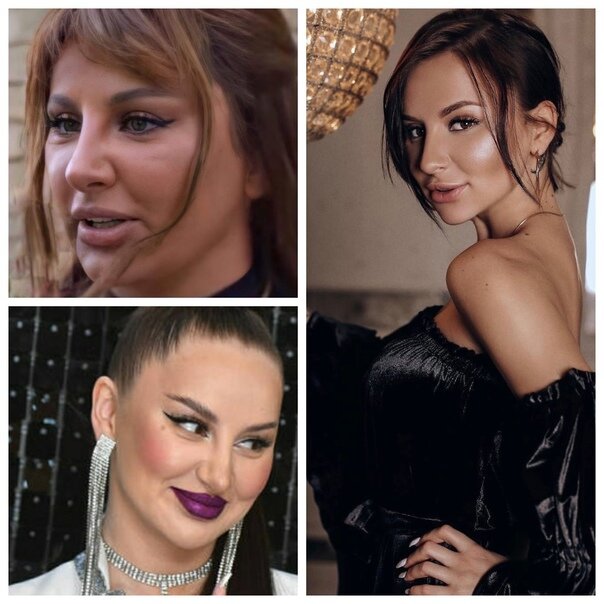 Асти до и после пластики