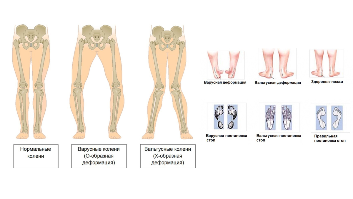 Варусная деформация стоп и коленей
