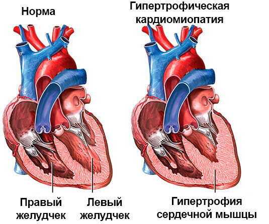 Кардиопатия сердца что это у взрослого. Кардиомиопатическая гипертрофия. Сердце спортсмена и обычного человека. Кардиомиопатия картинки. Гипертрофированное сердце.