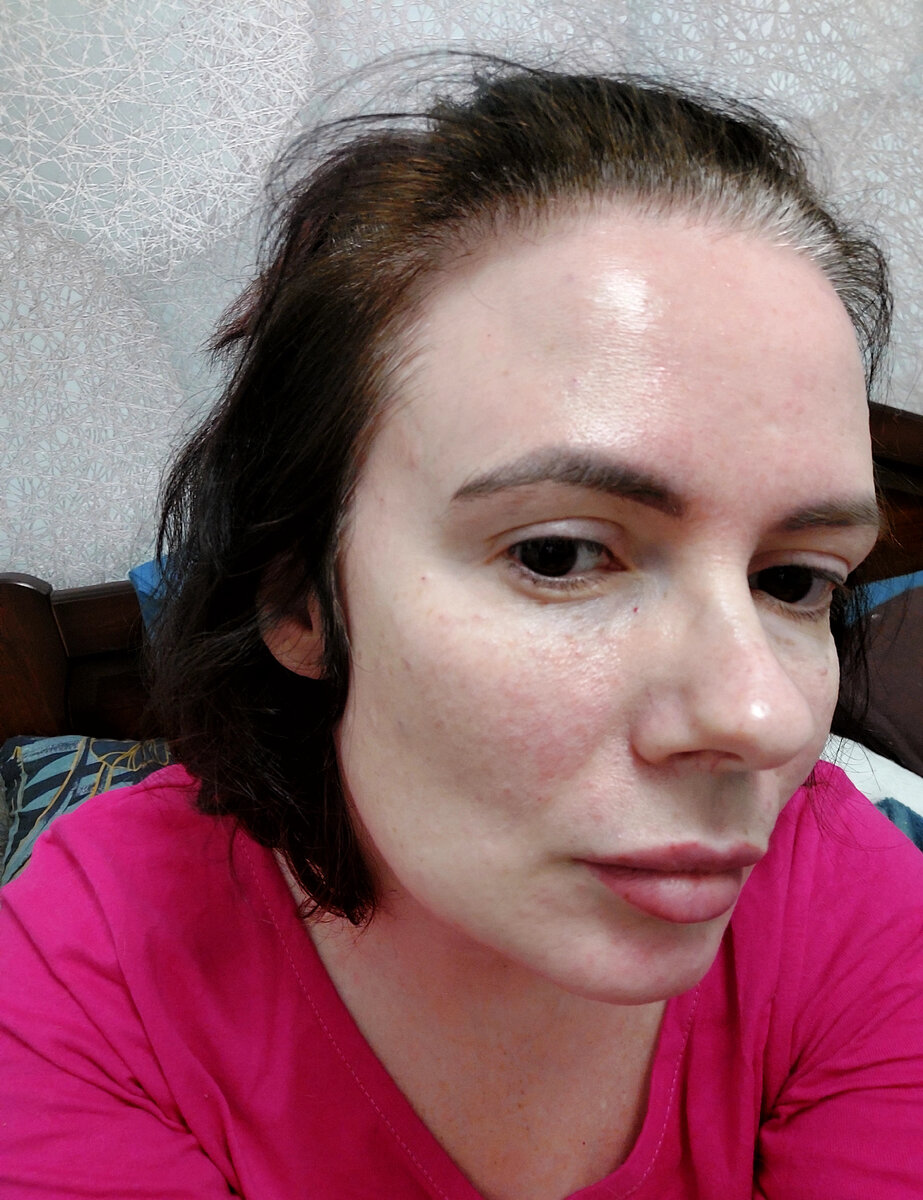 А это сейчас, спустя полтора часа. Следы уменьшаются на глазах, это радует.