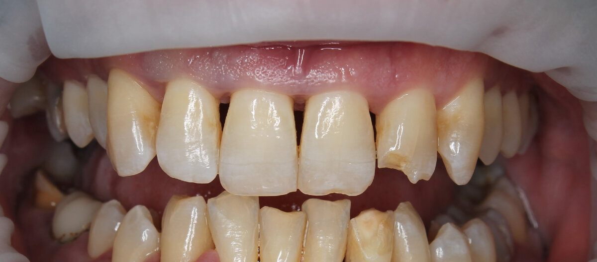 Результат успешного лечения дёсен - да, ошибки нет. Подробности в конце статьи