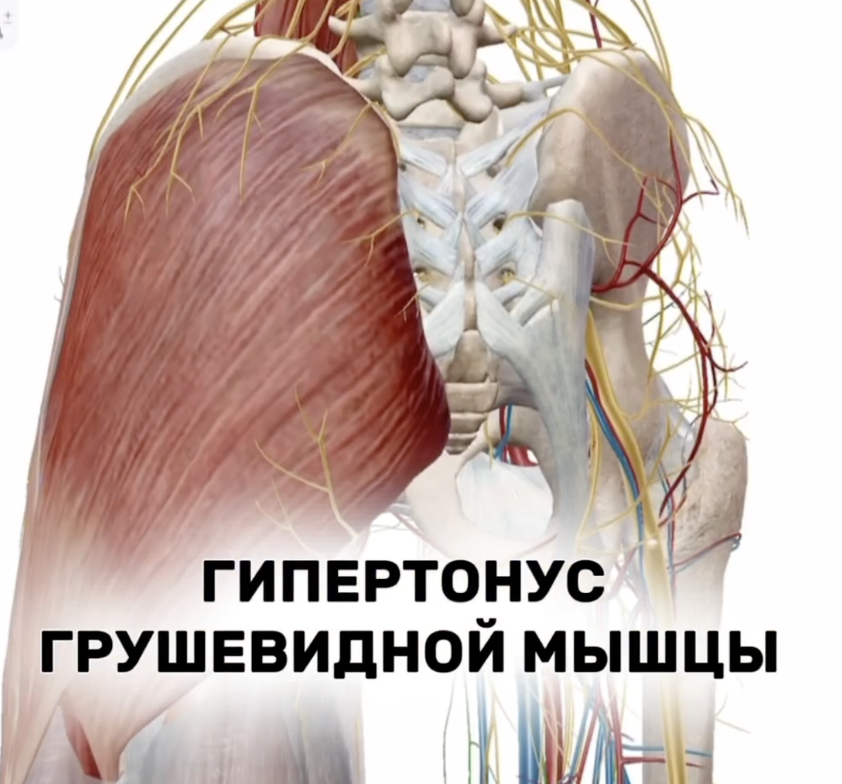 Боль в ягодице, синдром грушевидной мышцы – причины, диагностика, лечение