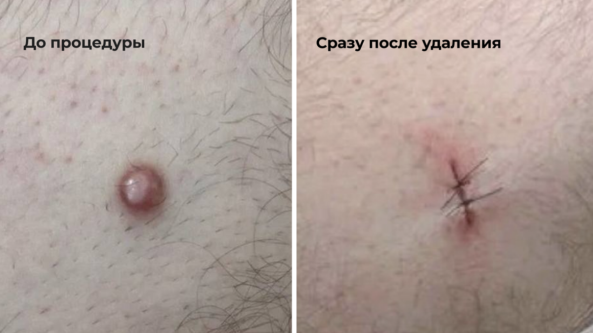 Удаление дерматофибромы: до и после