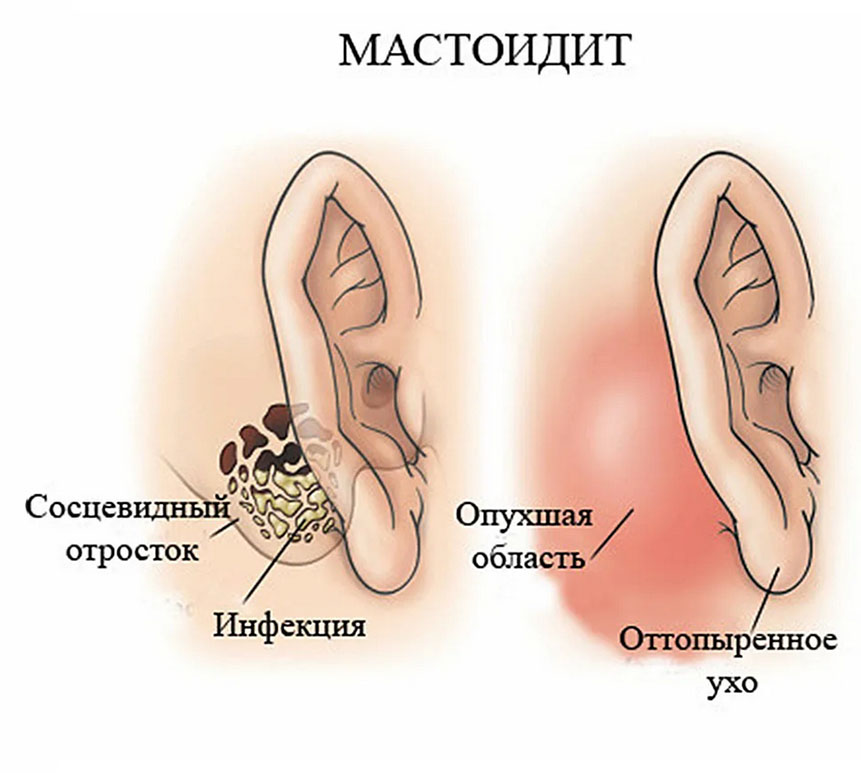 Флегмоны шеи