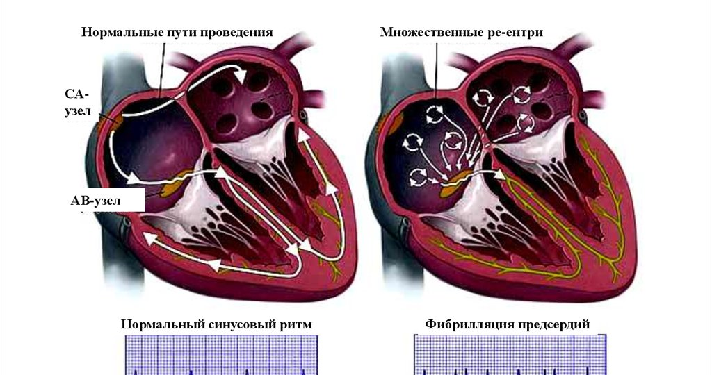 Как живут люди с фибрилляцией предсердий (мерцательной аритмией)?