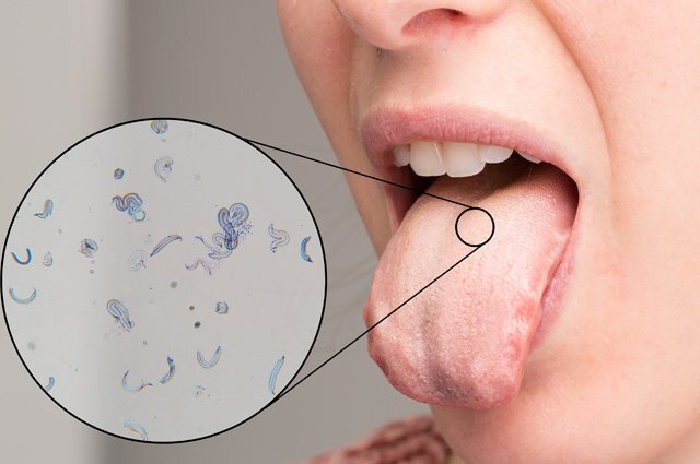    Чем можно лечить стоматит в домашних условиях?