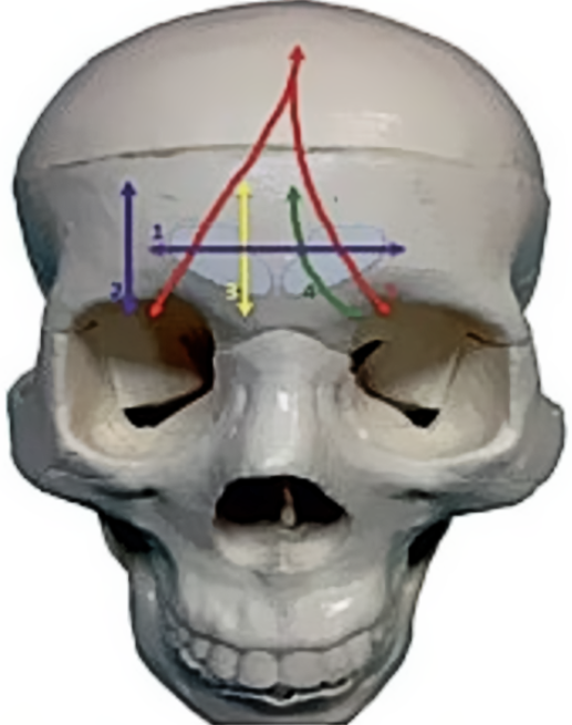 Рис. 1: Типы переломов лобной пазухи.