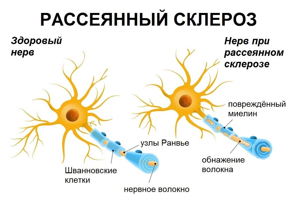 Рассеянный склероз ✔: симптомы, признаки и причины, диагностика и лечение