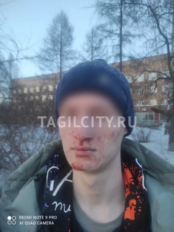 В Нижнем Тагиле пятеро молодых людей неславянской внешности сломали 17-летнему подростку нос. Об этом сообщает паблик ВК [ТТ] НИЖНИЙ ТАГИЛ.-2