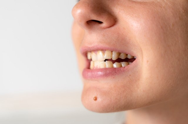 Как отбелить зубы в домашних условиях: 15 простых методов