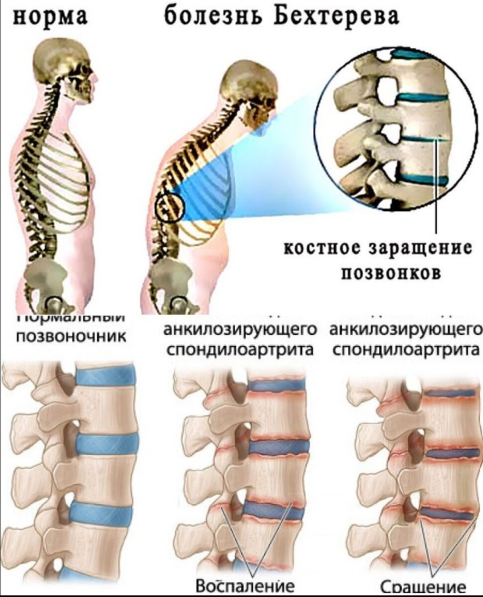 Анализы при миозите