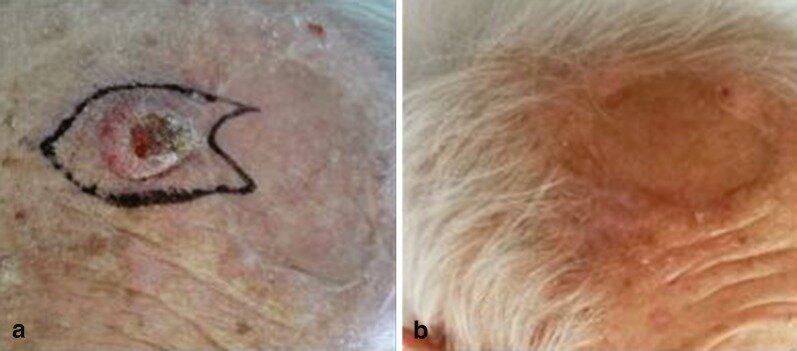 Кератоакантома до лечения (а) и полный ответ после терапии (b). Первоисточник - Gualdi G, Caravello S, Frasci F, Giuliani F, Moro R, Fargnoli MC, Ciciarelli V, Argenziano G, Giorgio CM, Requena C, Nagore E, Sanmartín O, Martorell A, Fantini F, Calzavara-Pinton P, Amerio P. Intralesional Methotrexate for the Treatment of Advanced Keratinocytic Tumors: A Multi-Center Retrospective Study. Dermatol Ther (Heidelb). 2020 Aug;10(4):769-777. doi: 10.1007/s13555-020-00400-z. Epub 2020 Jun 13.  
Intralesional Methotrexate for the Treatment of Advanced Keratinocytic Tumors: A Multi-Center Retrospective Study - PubMed (nih.gov)