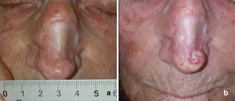 Базальноклеточный рак на коже носа до начала терапии (а) и прогрессирование несмотря на проводимую терапию (b). Первоисточник - Gualdi G, Caravello S, Frasci F, Giuliani F, Moro R, Fargnoli MC, Ciciarelli V, Argenziano G, Giorgio CM, Requena C, Nagore E, Sanmartín O, Martorell A, Fantini F, Calzavara-Pinton P, Amerio P. Intralesional Methotrexate for the Treatment of Advanced Keratinocytic Tumors: A Multi-Center Retrospective Study. Dermatol Ther (Heidelb). 2020 Aug;10(4):769-777. doi: 10.1007/s13555-020-00400-z. Epub 2020 Jun 13.  
Intralesional Methotrexate for the Treatment of Advanced Keratinocytic Tumors: A Multi-Center Retrospective Study - PubMed (nih.gov)