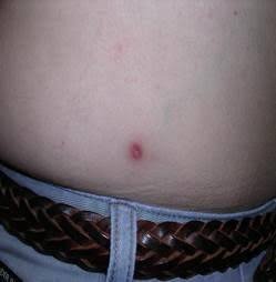 Реакция на укус клеща.
Источник: hopkinslyme.org