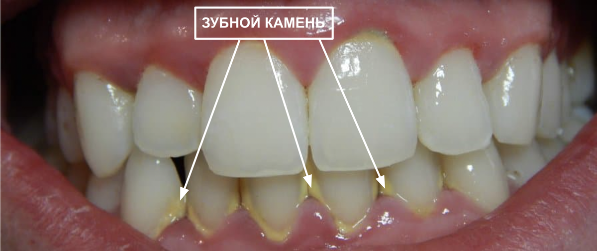 Так выглядит зубной камень на зубах