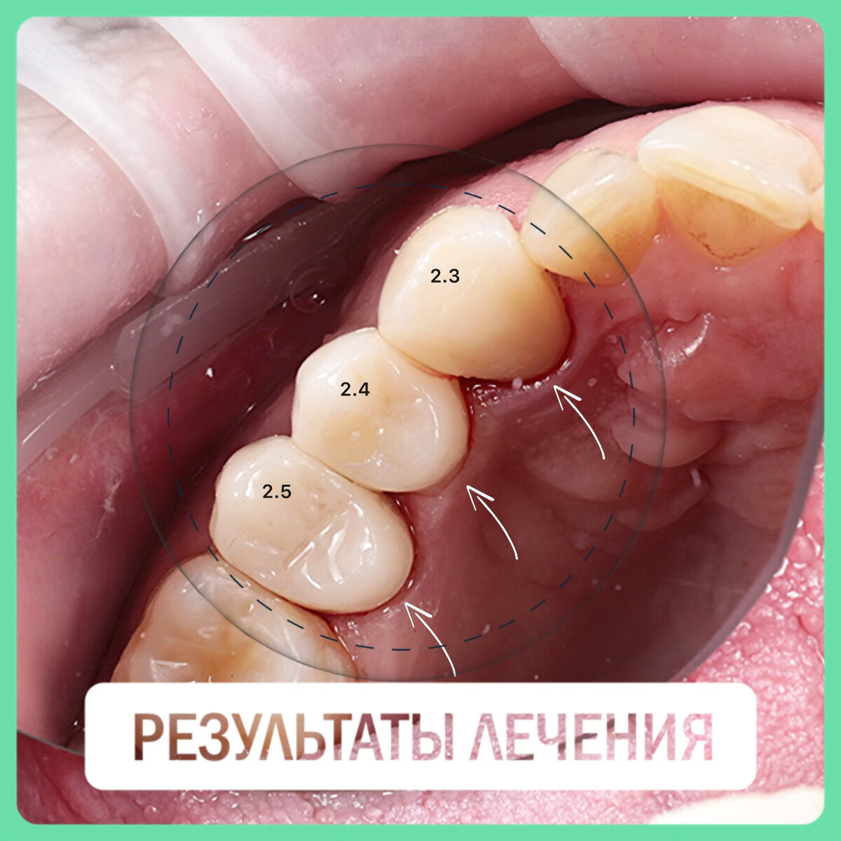 Изначальная клиническая ситуация у пациента мужчины в возрасте 40 лет:
Мостовидная конструкция из металлокерамики с опорой на свои зубы (23, 24 (отсутствует), 25).