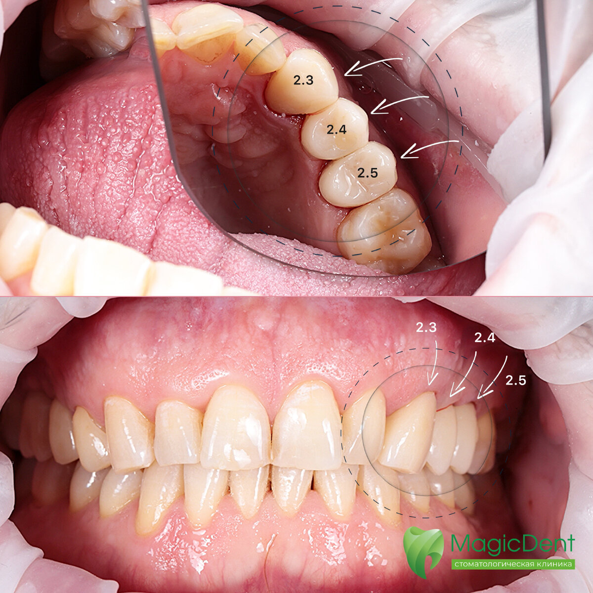 Изначальная клиническая ситуация у пациента мужчины в возрасте 40 лет:
Мостовидная конструкция из металлокерамики с опорой на свои зубы (23, 24 (отсутствует), 25).-2