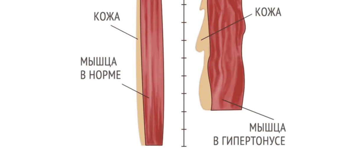 Гипертонус что это. Тонус мышц. Мышца в гипертонусе. Гипертонус мышц. Гипер мышцы.