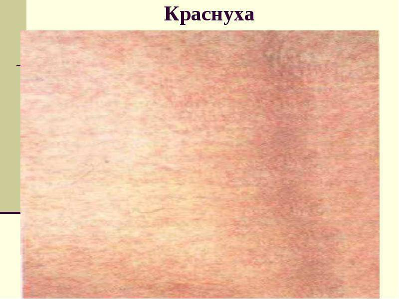 Аннулярная сыпь фото Симптомы краснухи у детей и подростков - первая помощь в лечении О детском здоро