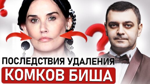 СДЕЛАТЬ скулы или ПОТЕРЯТЬ молодость | Последствия удаления комков Биша