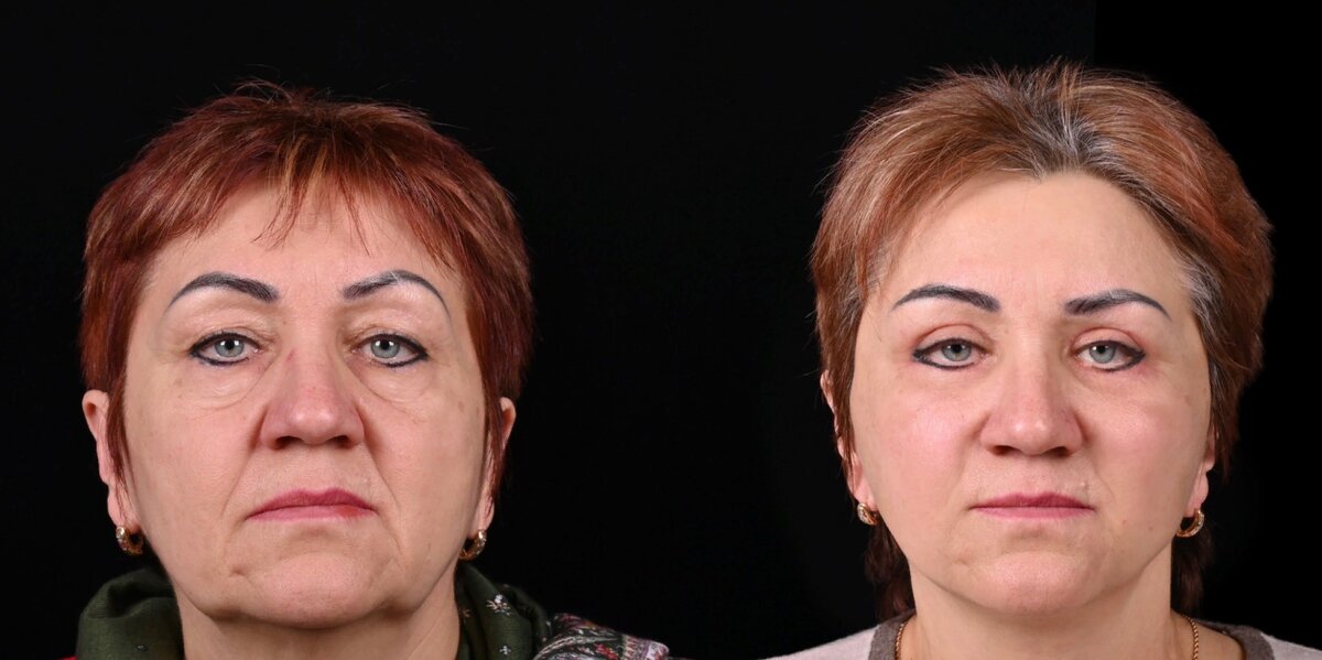 Проведен комплекс омолаживающих операций, включающий пластику верхних век и заполнение подглазничной области липофилингом. Фото до и после. Фото с сайта хирурга Д.Р. Гришкяна. Имеются противопоказания, требуется консультация специалиста