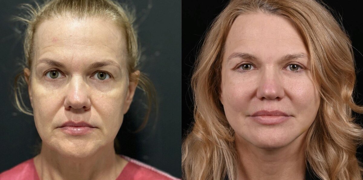 Провели пластику лица и шеи MACS-лифтинг, пластику верхних век с липофилингом и липофилинг среднемедиальной части лица. Фото до и после. Фото с сайта Д.Р. Гришкяна. Имеются противопоказания, требуется консультация специалистов