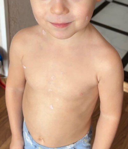 Фото сделано в начальной стадии заболевания (1-е сутки после высыпания)