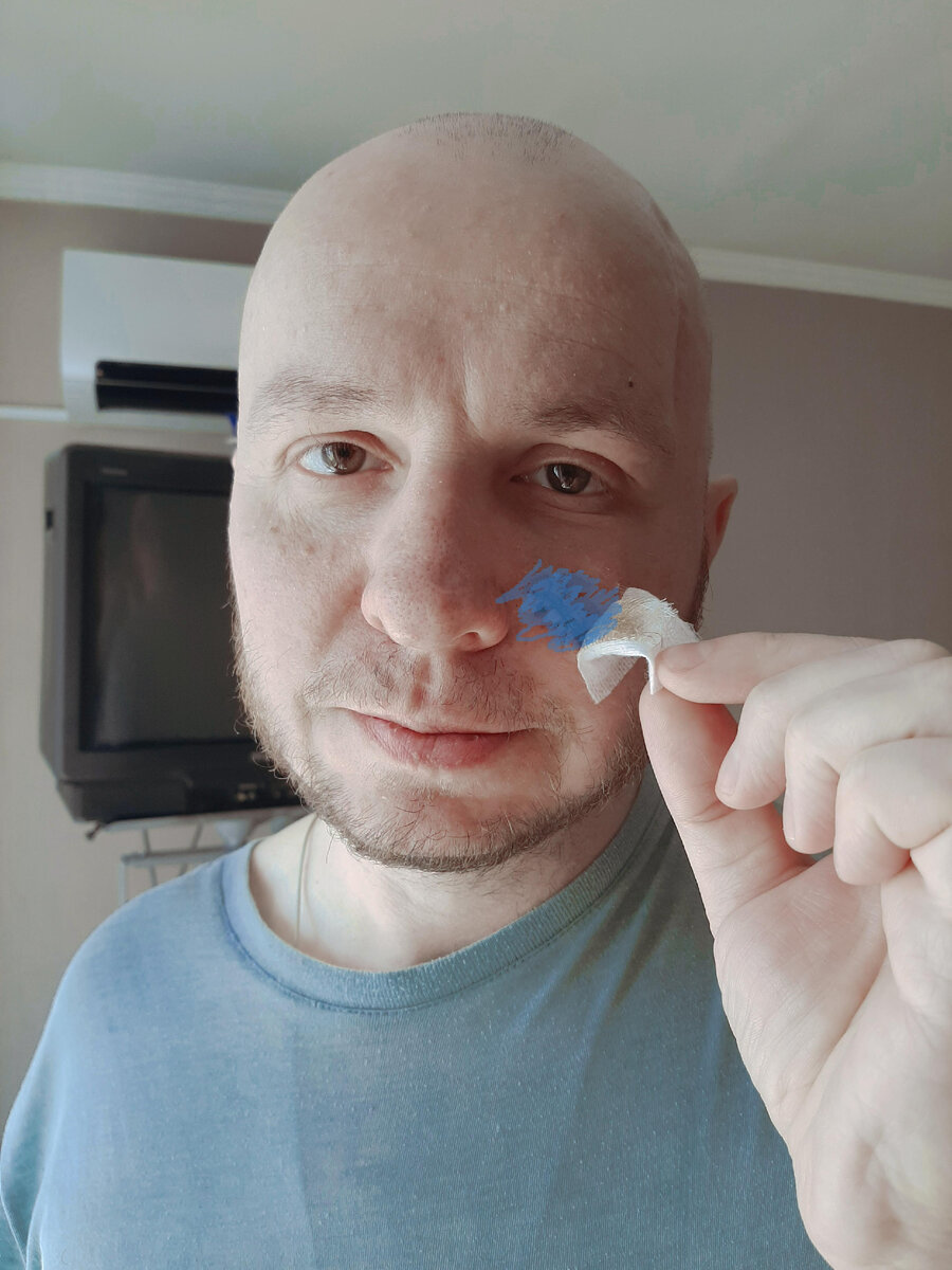 РАК МОЗГА. АФАЗИЯ. Как Рому заштопали. Глаз заплыл, но в целом сносно ...