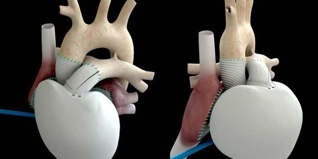 Как работает искусственное сердце? 