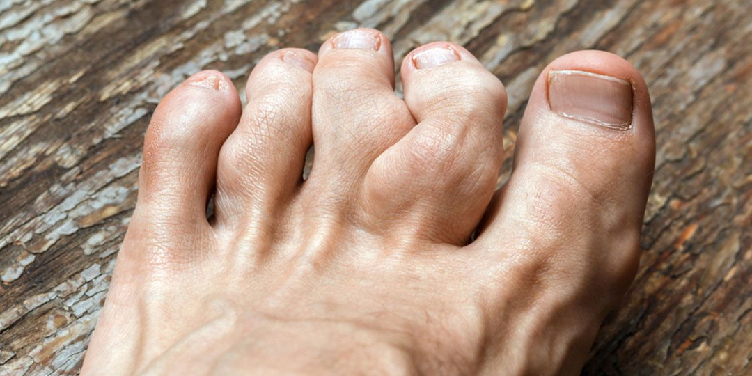 У меня подагра – это навсегда? Можно ли жить без приступов и проблем суставов, почек и всего организма?