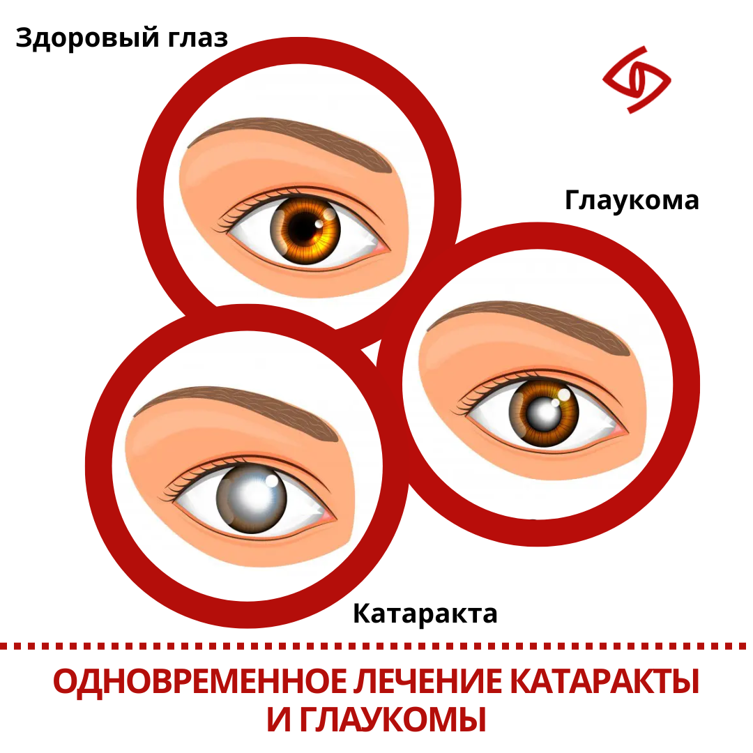 Одновременное проявление глаукомы и катаракты | Клиника доктора ...
