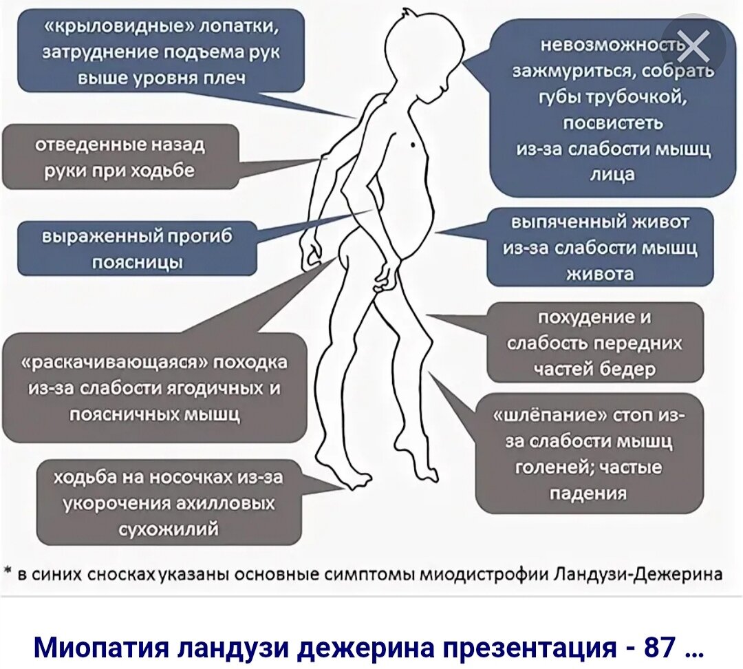 Дистрофия мышц лечение. Мышечная дистрофия миопатия. Миодистрофия Дюшенна-Беккера симптомы. Прогрессирующей мышечной дистрофией. Прогрессирующие мышечные дистрофии Дюшенна.