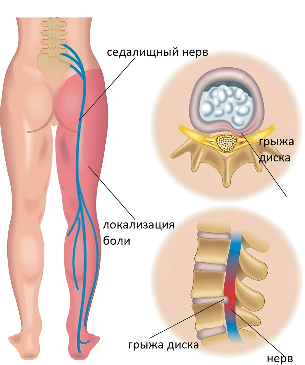 Грыжа диска поясничного отдела позвоночника