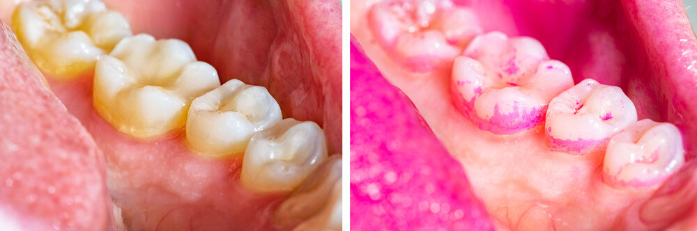 Многие слышали о зубном камне благодаря рекламе разных паст, однако воспринимают это явление не очень серьезно.-2