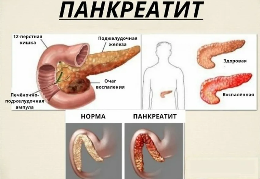 Что такое панкреатит простыми словами у женщин. Болезнь хронический панкреатит поджелудочной железы. Панкреатин поджелудочная железа. Хронические заболевания поджелудочной железы.