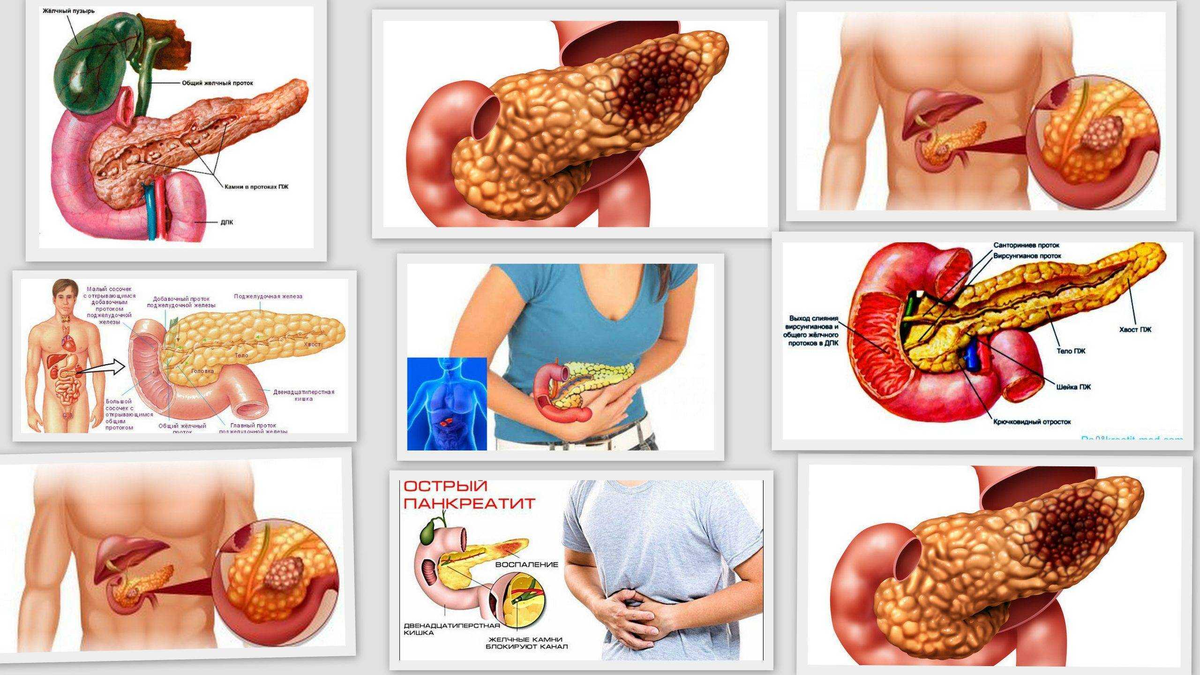 Острый панкреатит - это больно и очень опасно. Почему нельзя лечиться  самому? | О здоровье: с медицинского на русский | Дзен