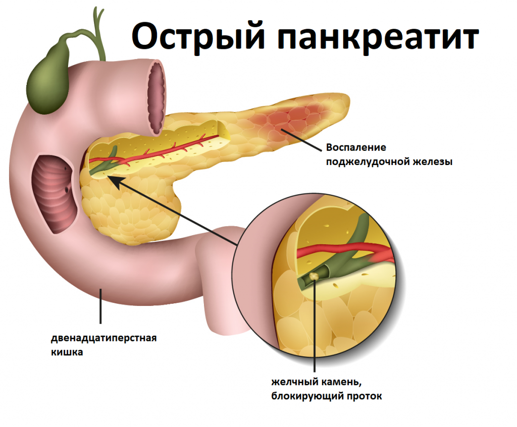 Панкреатит