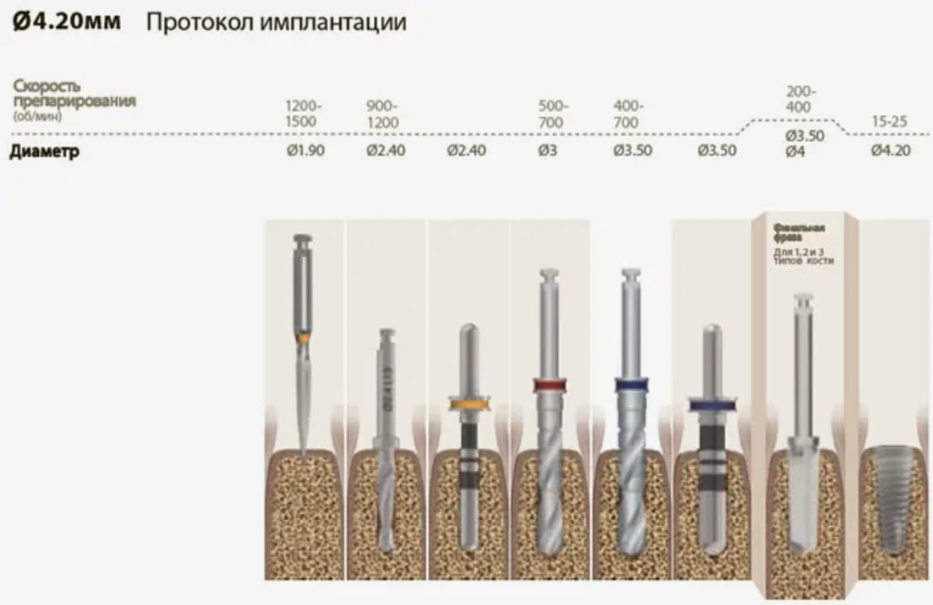 Последовательность использования различных фрез при установке имплантата