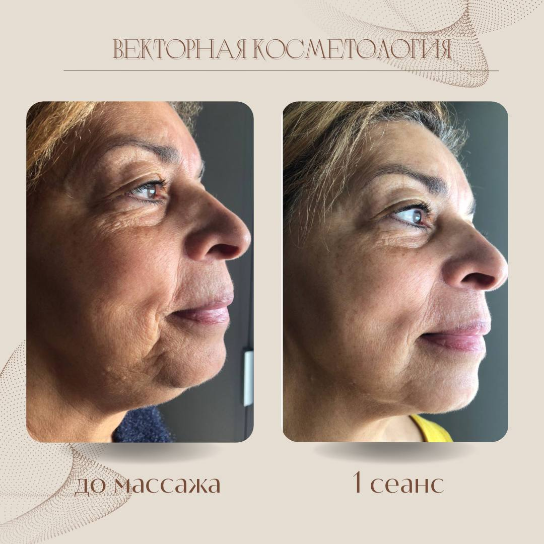 результат 1 процедуры Векторного массажа лица