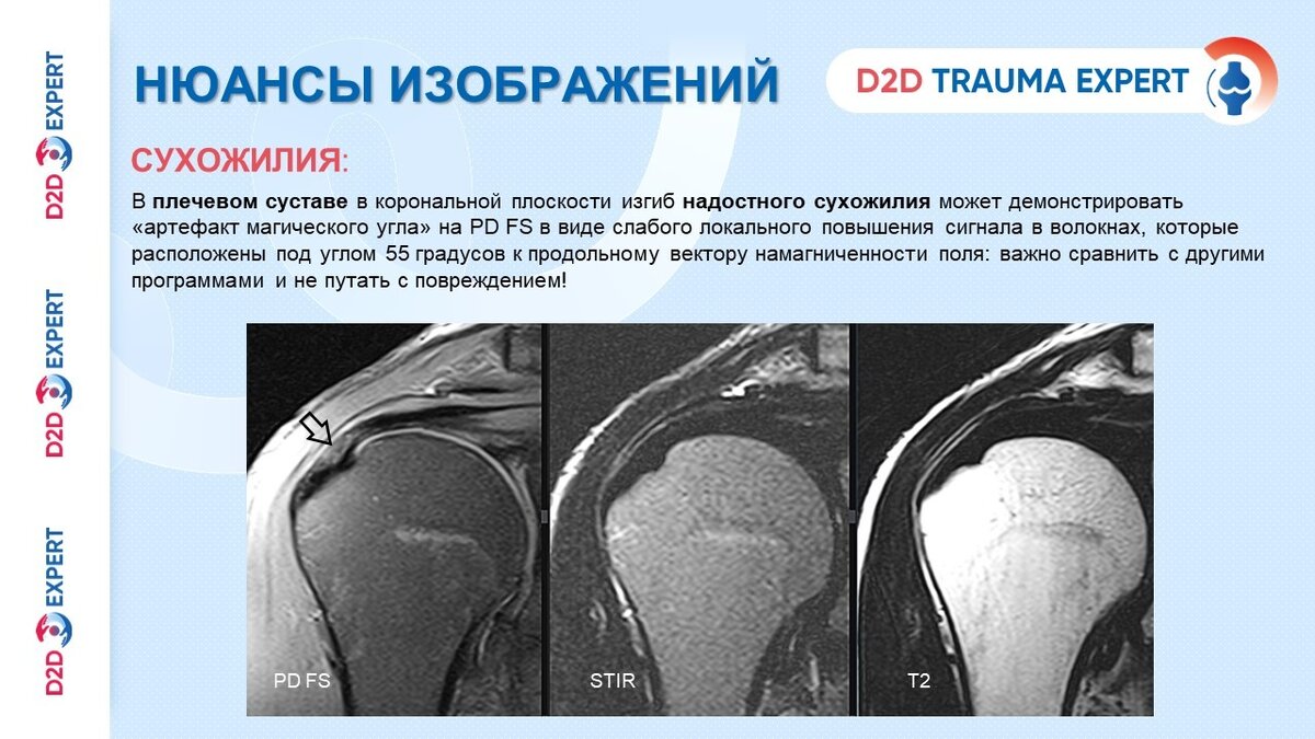 сухожилия разгибателя 1 пальца стопы. медиальный эпикондилит сухожилия. локоть теннисиста латеральный эпикондилит. бурсит гусиной лапки коленного сустава. удерживатель сгибателей стопы.